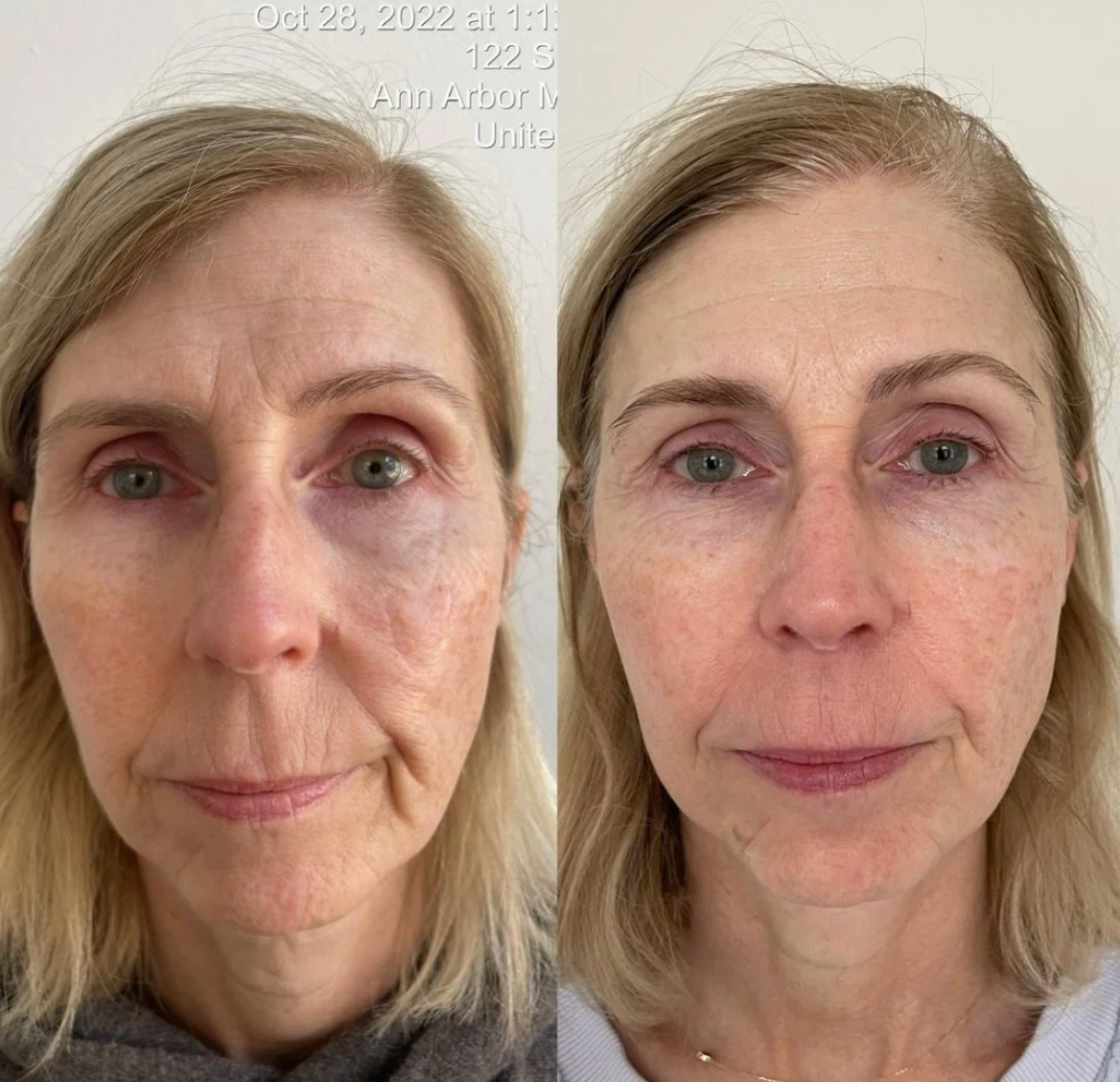 KrX Youthplex Face Lift Toning Solution